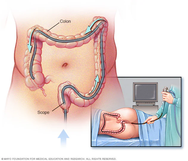 Anatomical pathway of the colonoscope along the rectum, sigmoid, descending, transverse and ascending colon to the caecum.