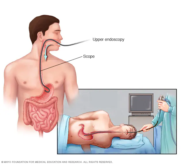 Anatomical pathway of upper gastrointestinal endoscopy (OGD) through the oesophagus, stomach and duodenum.